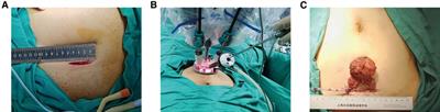 Extraperitoneal tissue retraction technique: An effective assistant of extraperitoneal pure single-port robotic-assisted radical prostatectomy with the da Vinci Si surgical system